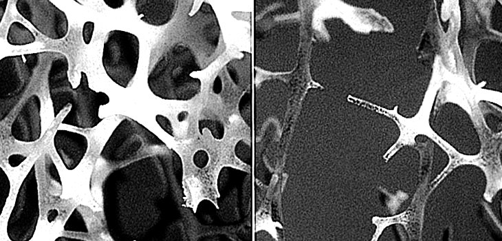 Screen Gastric Bypass Patients Due to Bone Effects?