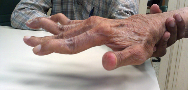 Milestone Study Accurately Predicts Rheumatoid Arthritis