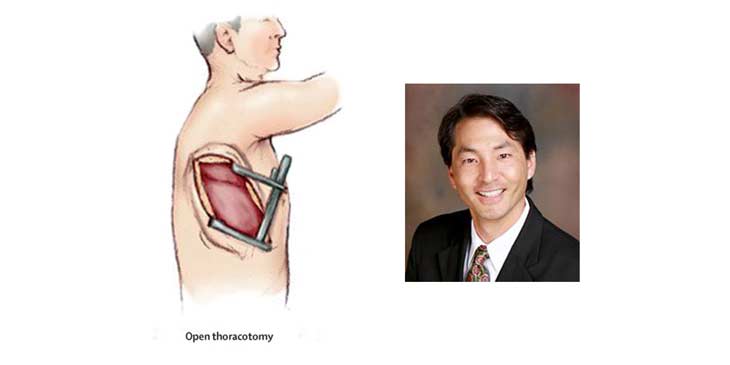 Novel Muscle-sparing Thoracotomy Improves Exposure