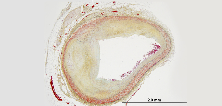 Certain Blood Antibody Mitigates Osteoporosis