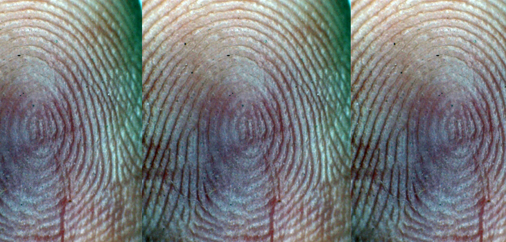 Mapping the “Pathological Fingerprint” of Osteoarthritis