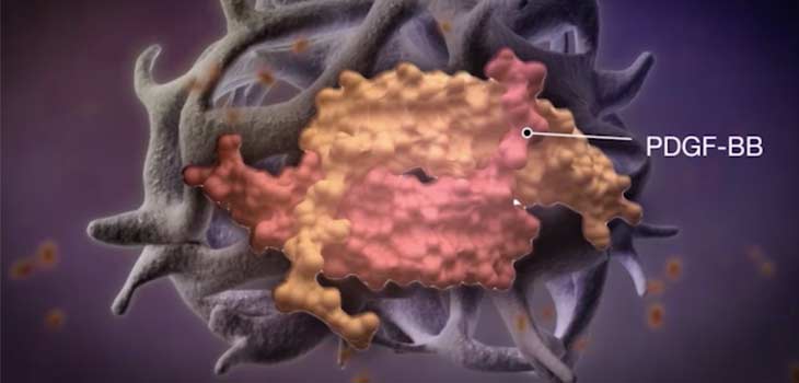FDA Approves Injectable rhPDGF Bone Graft