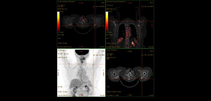 Mount Sinai Researchers Find OA Regulating Gene