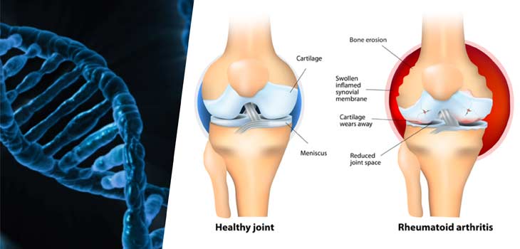 New Gene for Severity of Rheumatoid Arthritis?