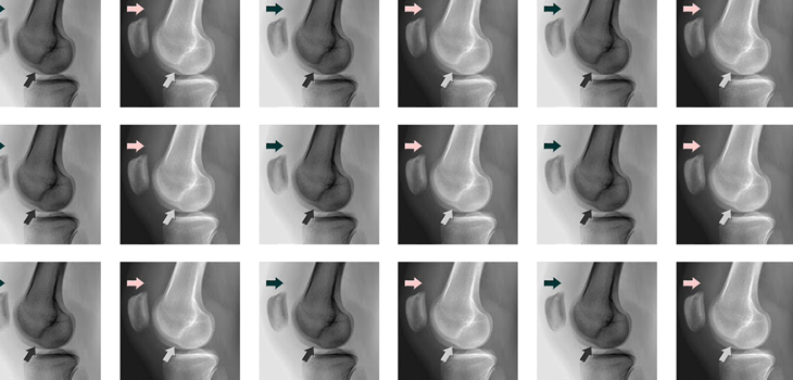 Criteria for Osteochondral Graft Matching Too Restrictive?