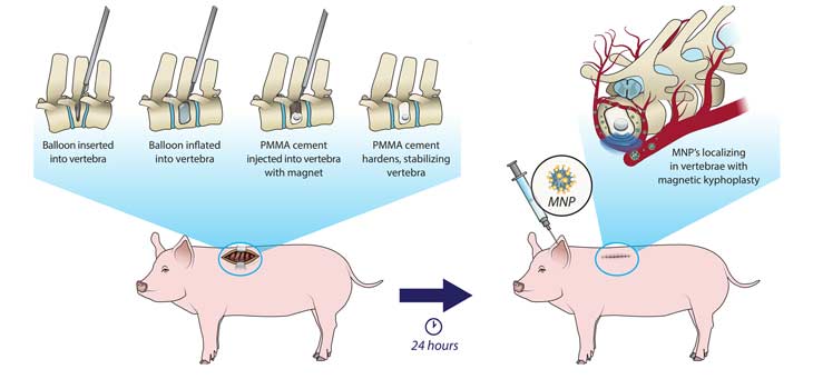 Magnetically Guided Drug Delivery for Kyphoplasty?