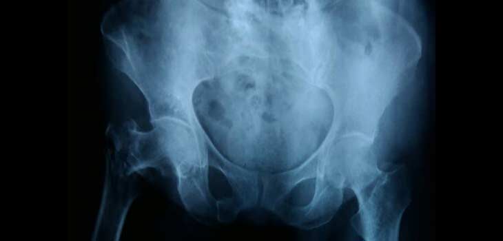 Study: Long-Term Mortality Risk Following Fractures
