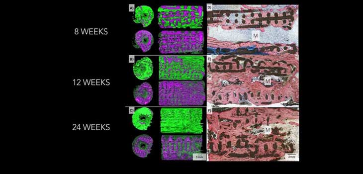 Dipyridamole Coated 3D Printed Implants Grow Bone