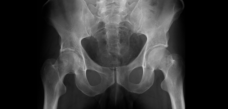 Acetabular Reconstruction: What Happens to Graft Bone Over Time?