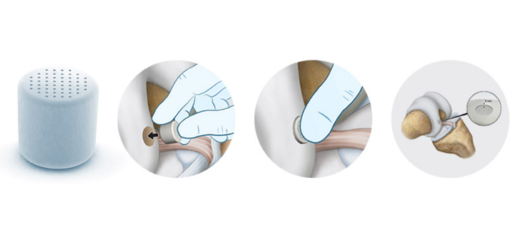 First U.S. Patients Receive Agili-C Implants