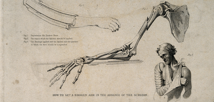 Fractures – Any Fractures – Shorten Life Expectancy