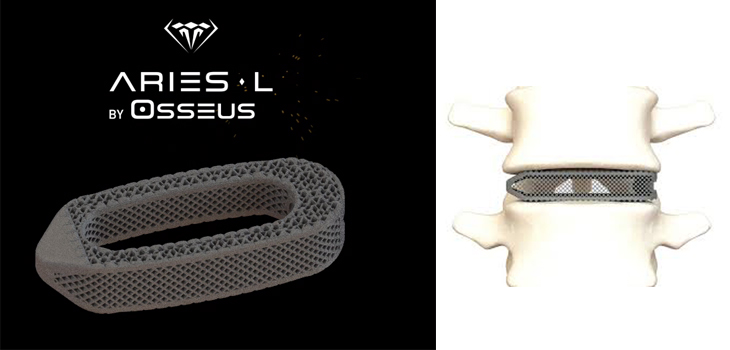 FDA Clears Osseus’ Aries 3D-Printed Lumbar Devices