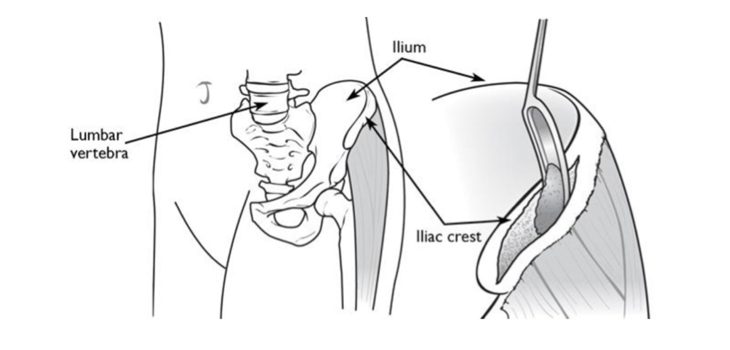 Can Iliac Crest Bone Graft Be Cheaper Than BMP?