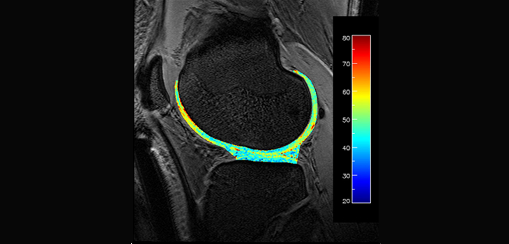 2,007 Knees Reveal Cartilage Degeneration Clues
