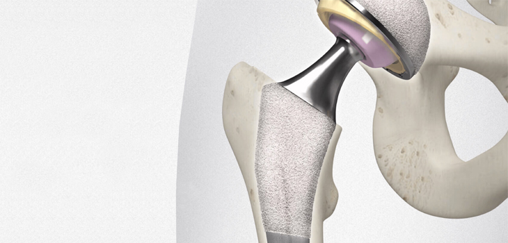 b-ONE Total Hip Cleared by FDA
