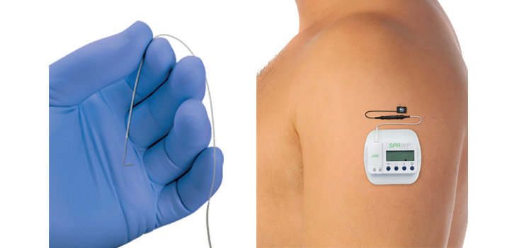 Clearance for Only Percutaneous PNS System in U.S.