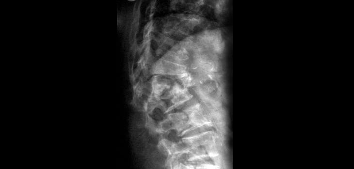What Pushes Thromboembolic Events Rates Up?