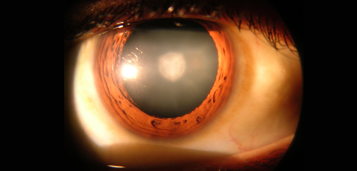 Cataracts Linked to Osteoporosis, Fracture?
