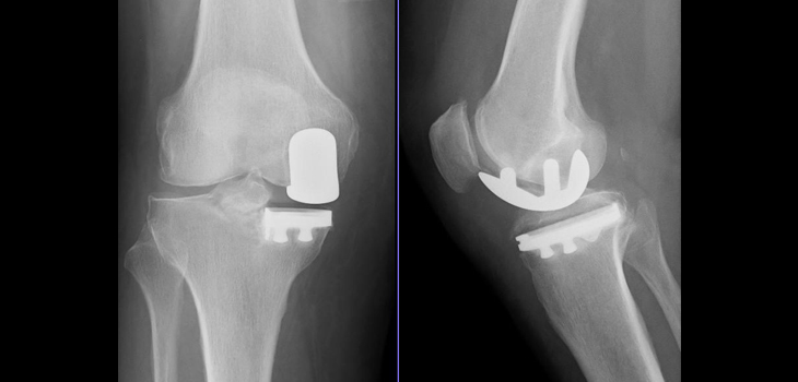 Unicompartmental Knee Arthroplasty for ALL Patients?