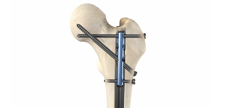 OrthoXel’s Femoral Nail Cleared by FDA