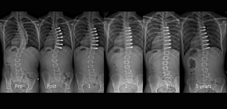Study: Tethering “Reasonable” in Certain Thoracic Scoliosis Cases