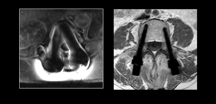 CarboFix Pedicle Screw System Cleared by FDA for Oncology Patients