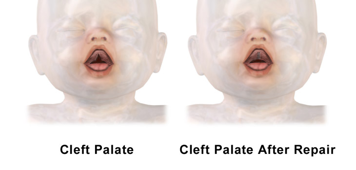 Umbilical Cord Blood Heals Clef Palates in Infants