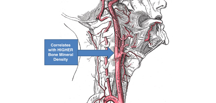 Thick Carotid Arteries=HIGHER Bone Mineral Density?