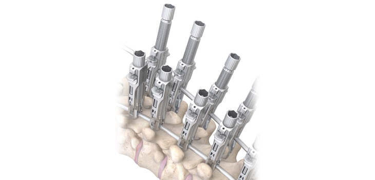 FDA Clears Smaller Spinal Implants for Kids