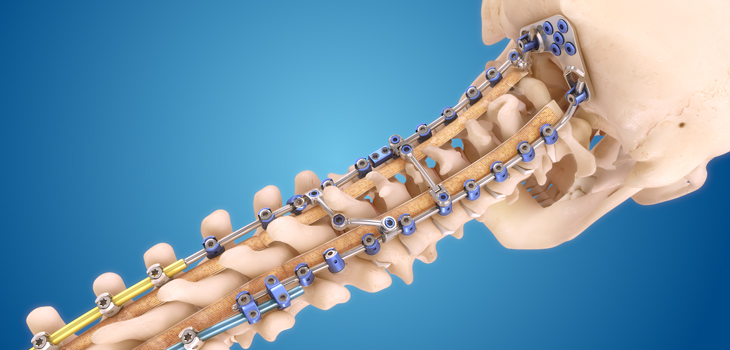 Infinity Occipitocervical-Upper Thoracic System Launched