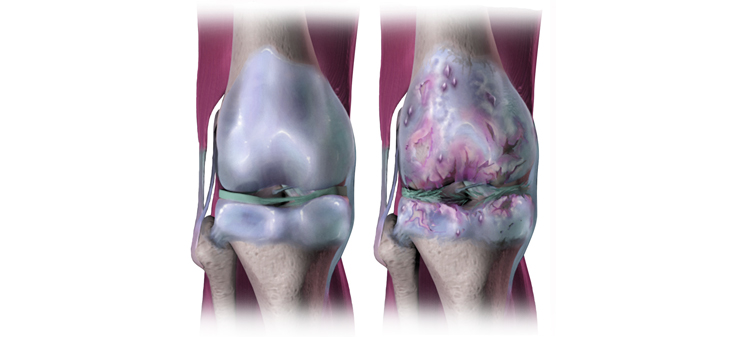 Molecule Protects Cartilage From Damage During Osteoarthritis?