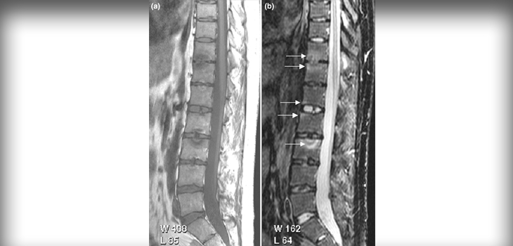 Psoriatic Arthritis: Rule Out Spondyloarthritis?