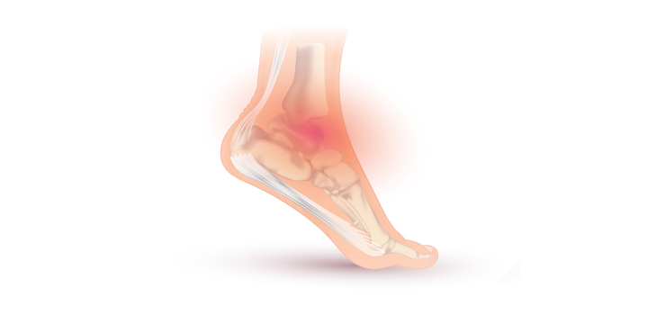 Researchers Find New Osteochondral Ankle Lesion Treatment
