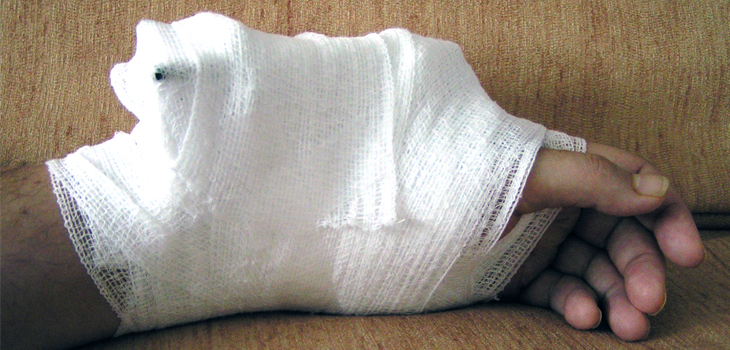 Study: Unusually High Chance of Secondary Fractures in Men