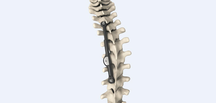 ApiFix: 250+ Scoliosis Patients Treated