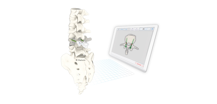 Medacta: Full-Market Release of Customizable Guides