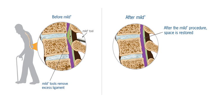 Vertos: MOTION Study of MIS Decompression Using Fitbits