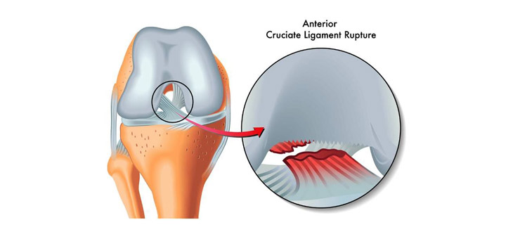 Researchers Pursuing Novel Ligament Reconstruction