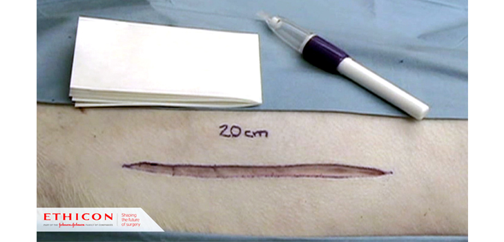 Study: Glue Skin Closure in Total Knee Arthroplasty?