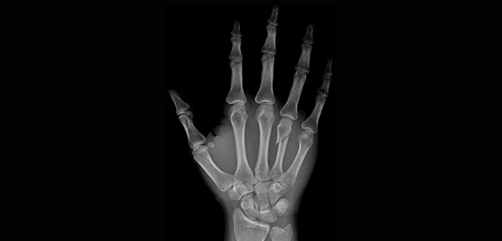 Prior Fracture Systemically Raises Fracture Risk