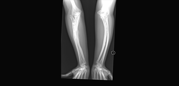 Osteogenesis Imperfecta: Millimeters Closer to a Treatment?