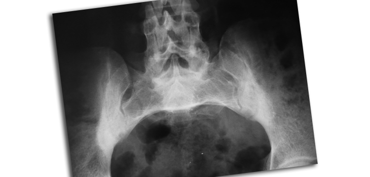 Unilateral Sacroiliitis: MRI or Tissue Studies for Diagnosis?