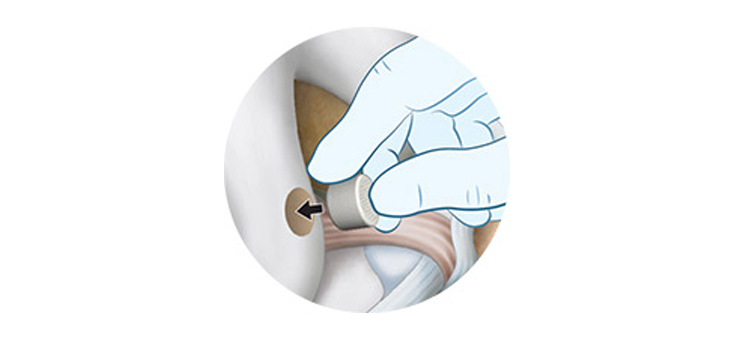CartiHeal Agili-C Implant Promotes Regeneration