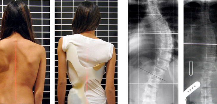 Study Validates Scoliosis Self-Perception Questionnaires