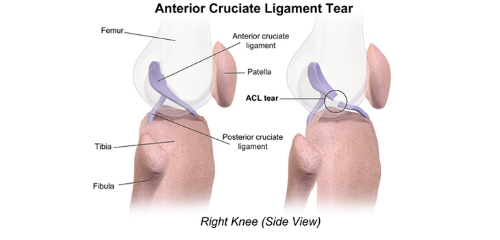Use Immune System to Prevent, Treat OA After ACL Tears?