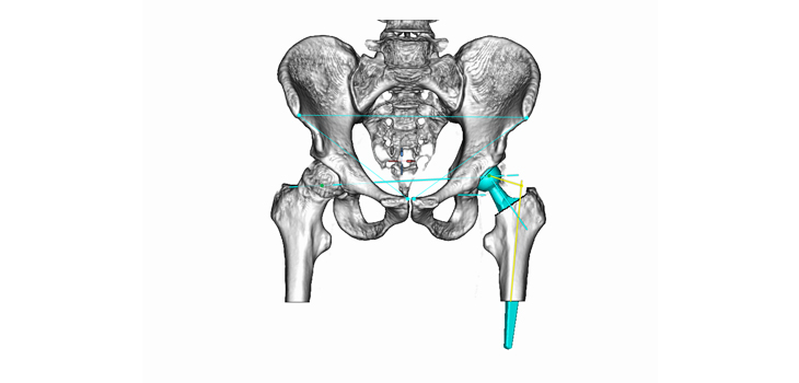 mediCAD: Preop Planning Tools Launched