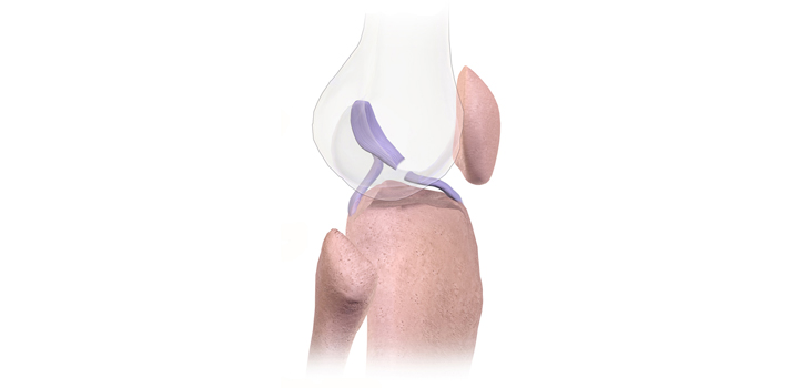 Graft Type, Not Tension, Determines ACL Tunnel Width