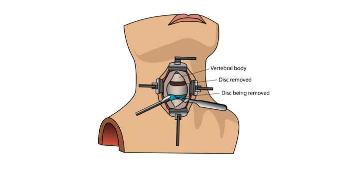 New Study: Cervical Discectomy Equivalent to Arthroplasty