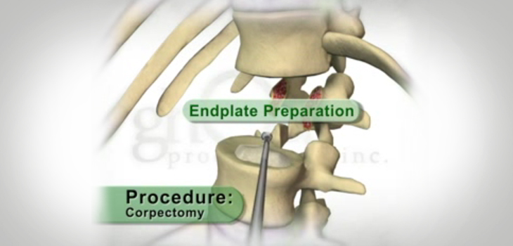 FDA Clears NuVasive Corpectomy System