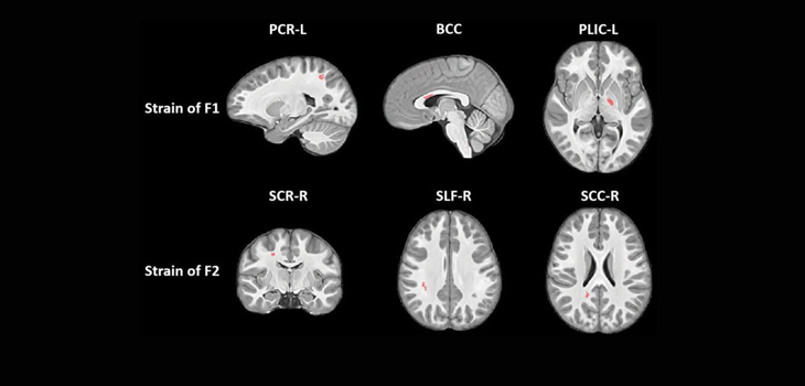 Youth Football Changes Nerve Fibers in Brain